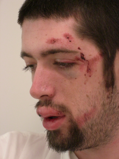 The shit by my eye is from getting sucker punched for seriously no reason other than the dude that did it gets drunk and pulls shit like that prob 30 minutes before falling off the bike. and I didn't bother going to the hospital either