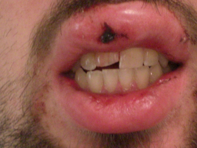 This is from a little over a year ago. The lip part is from face planting off my bike, my tooth went thru my lip then snapped off. Still got a tiny piece of that shit in my lip. It didn't hurt at all actually but that was prob due to the fact that I had drank enough to kill a small animal that night. still got a lump where my tooth went thru.